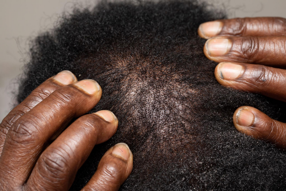 minoxidil shedding